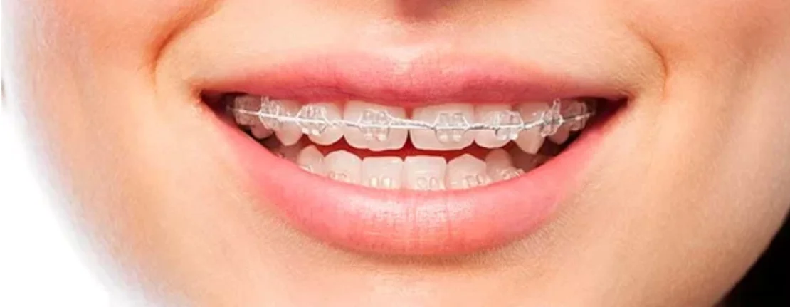 Cum să alegi corect un aparat dentar pentru copii?